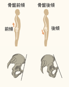 Flat-style diagram showing the difference between anterior pelvic tilt and posterior pelvic tilt, highlighting hip and spine alignment.